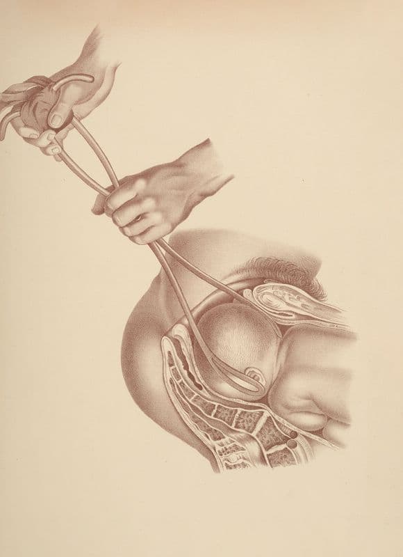Artificial Labor.—Application of the Forceps as a canvas print