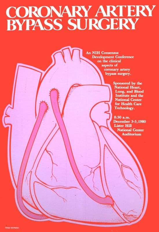 Coronary artery bypass surgery as a canvas print