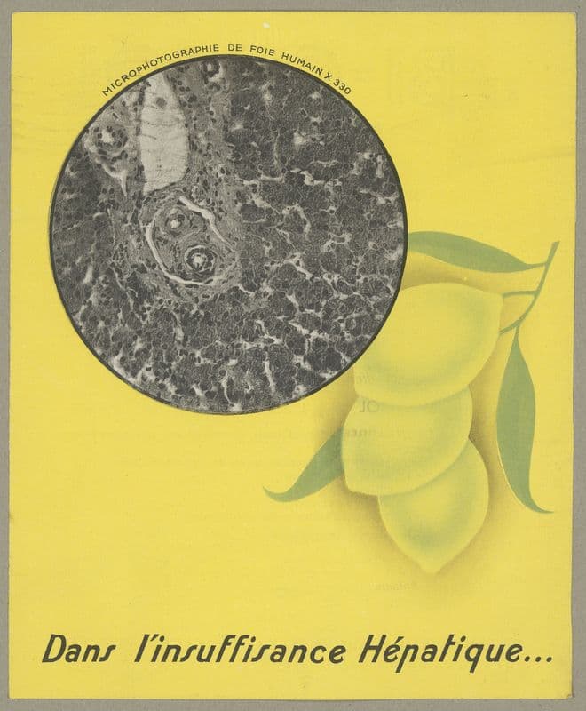 Dans l’insuffisance hépatique (1910-1950) as a canvas print
