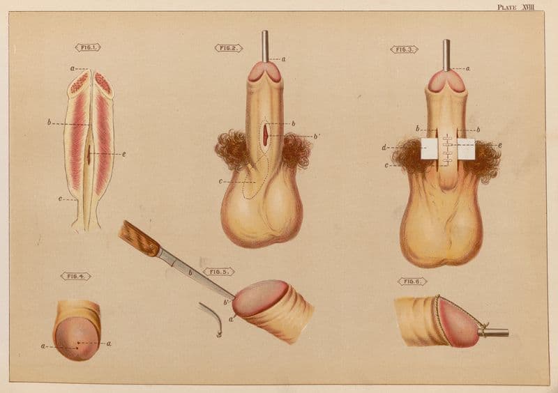 Operations upon the penis IV as a canvas print