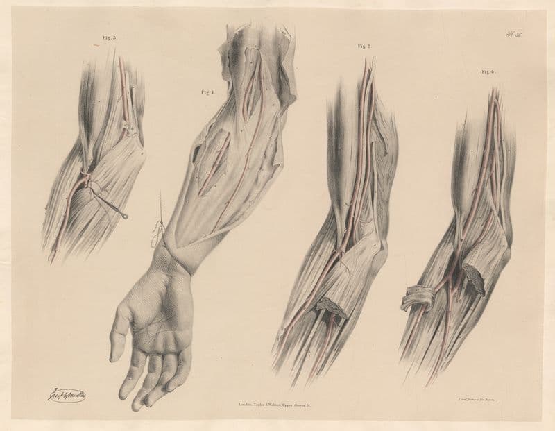Rare deviations of the Ulnar artery, Peculiarites of the Brachial artery as a canvas print